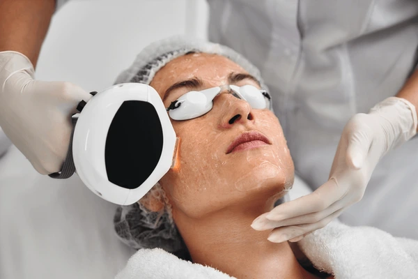Carbon Laser Treatment in Lucknow